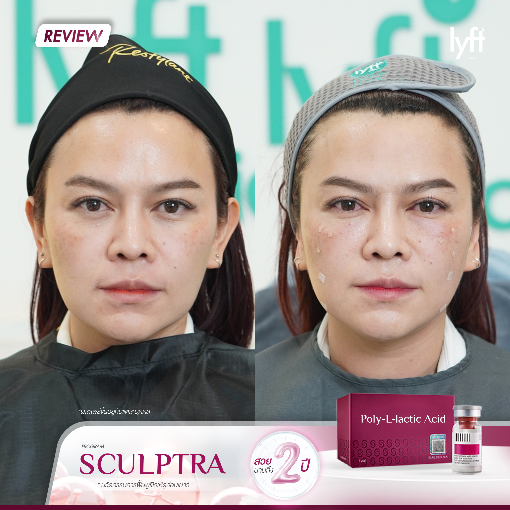 Sculptra-2.jpg